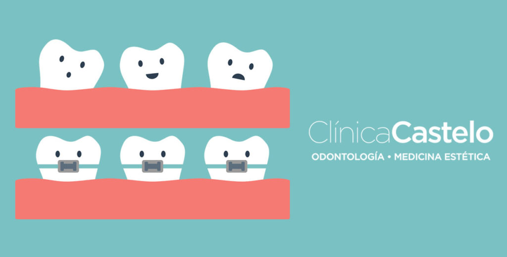 tipos de ortodoncia en Clínica Castelo