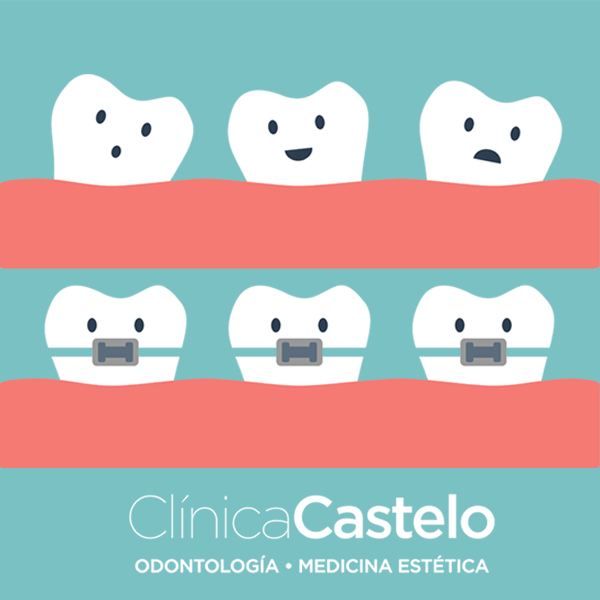 tipos de ortodoncia clinica castelo-dest
