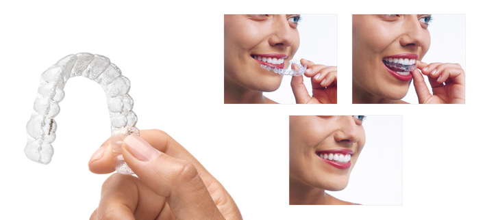 Invisalign antes y después con Clínica Castelo