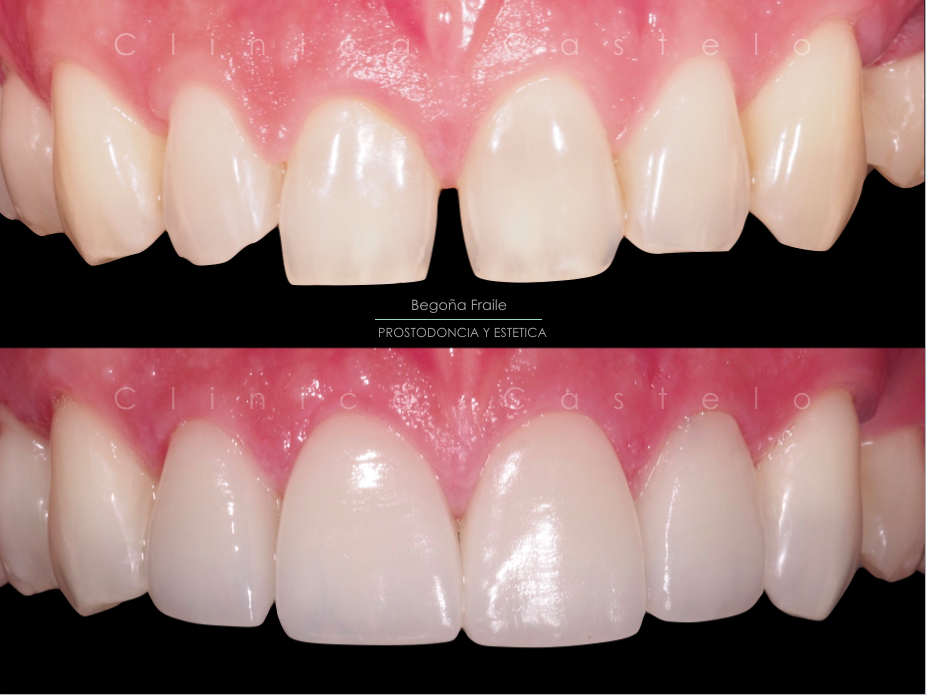 Diastema