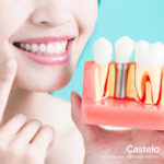 implantes dentales y osteoporosis en Clínica Castelo