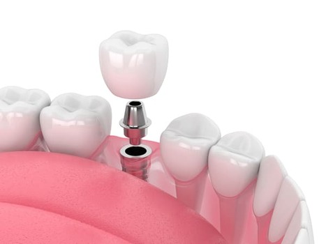 Implantes dentales clínica Castelo dentista