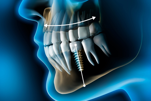 implantes dentales de vanguardia clínica Castelo dentista