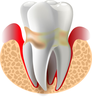 tratamiento periodoncia clínica Castelo dentista