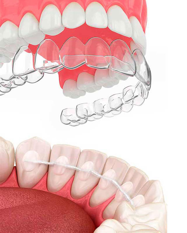 Imagen síntoma enfermedades periodontales clínica Castelo dentista