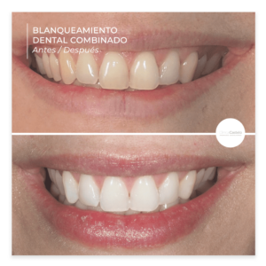 blanqueamiento dental combinado antes y despues