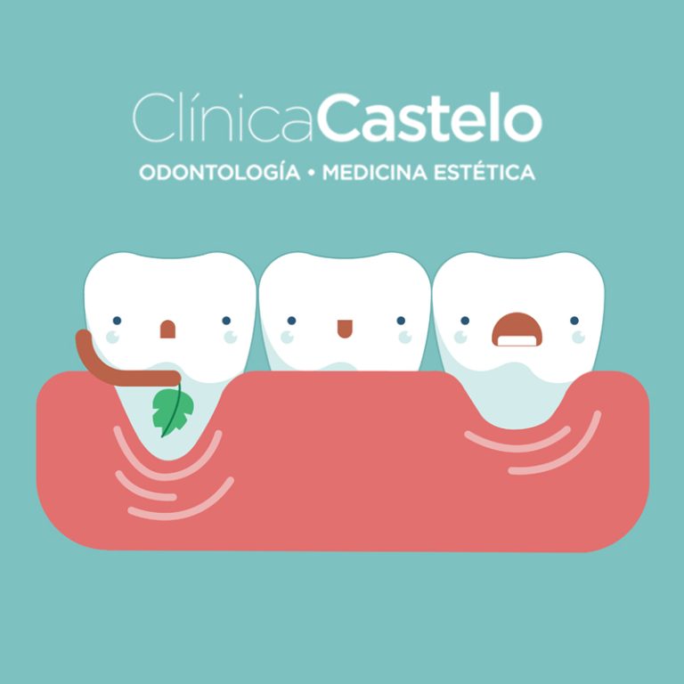 QUÉ ES LA SONRISA GINGIVAL-CLÍNICA CASTELO-DEST