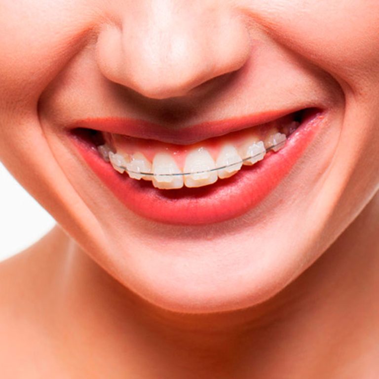 brackets-estéticos-de-zafiro-castelo-dest