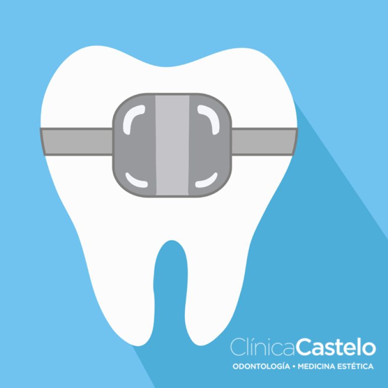 brackets estéticos de zafiro-clinica castelo-dest