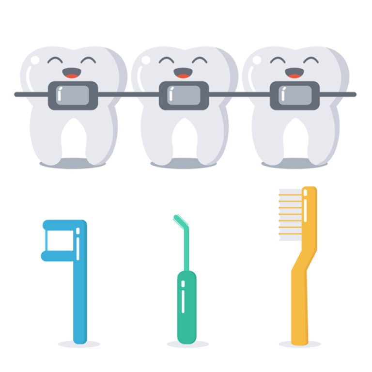 como cepillar los dientes con brackets metálicos-castelo-destc