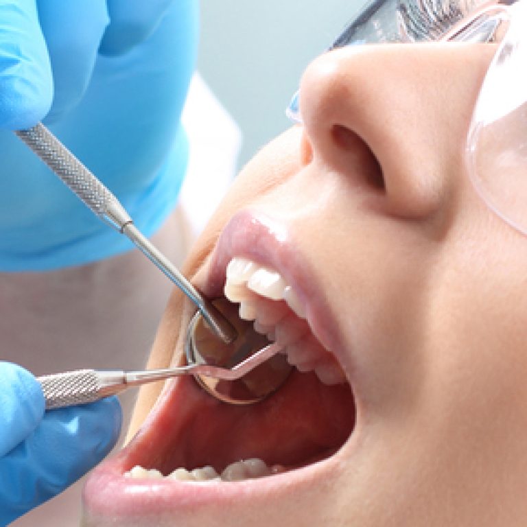 ¿Cuánto cuesta un empaste dental en Madrid? Clínica Dental Castelo.