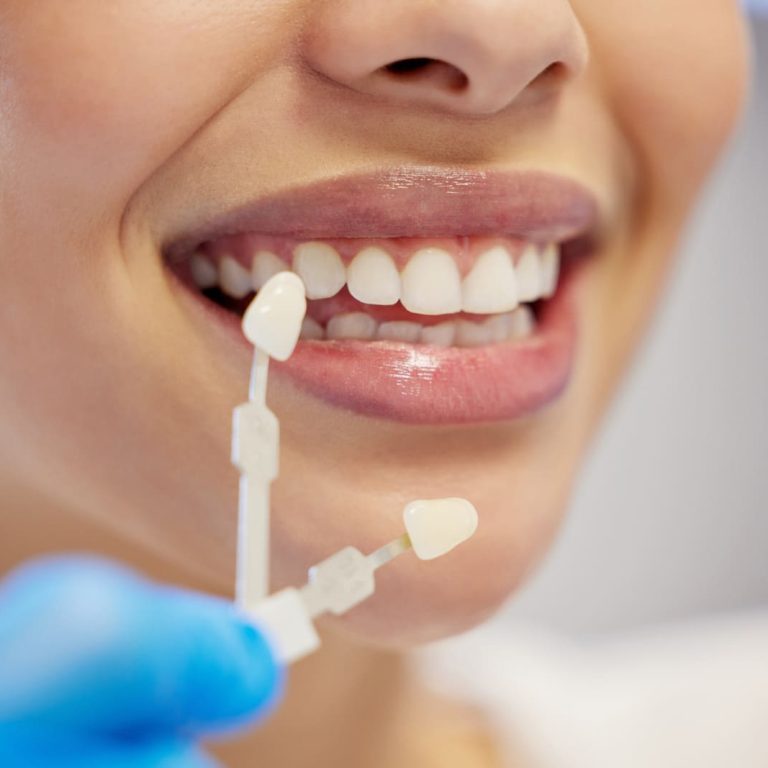 guía de color dental