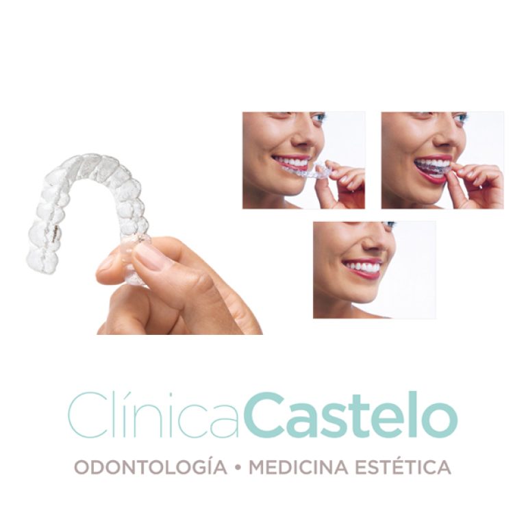 invisalign-antes-y-después-castelo